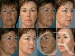 blepharoplasty-16.jpg