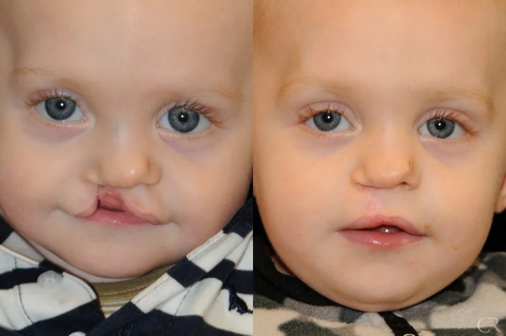 cleft-lip-23.jpg