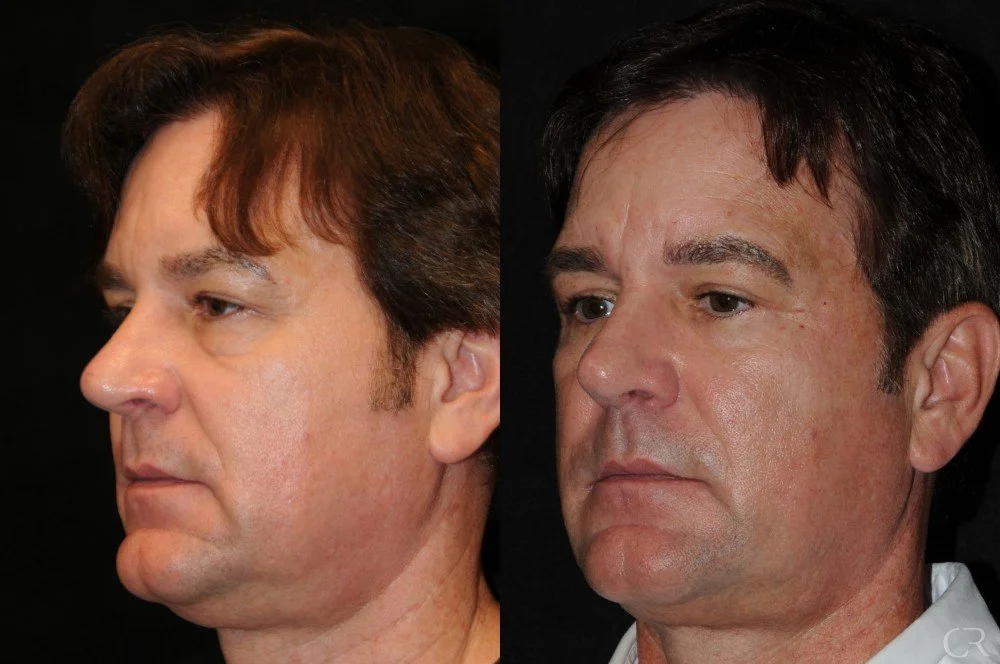 blepharoplasty-3.jpg