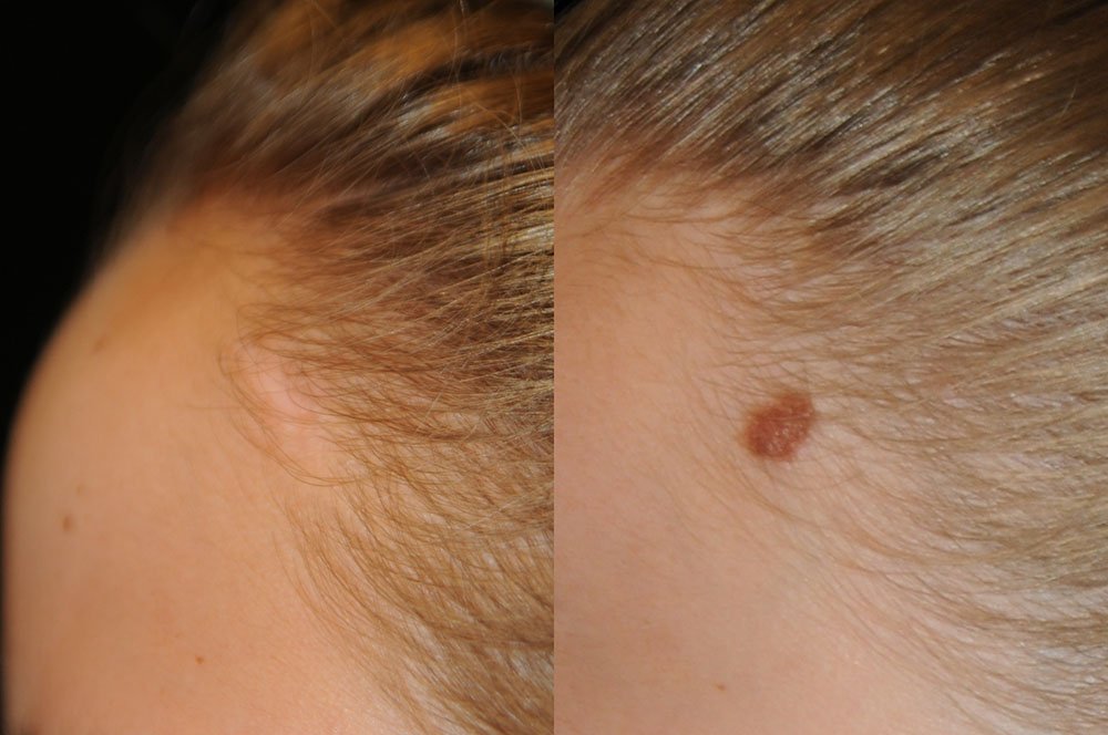 congenital nevus (4).jpg