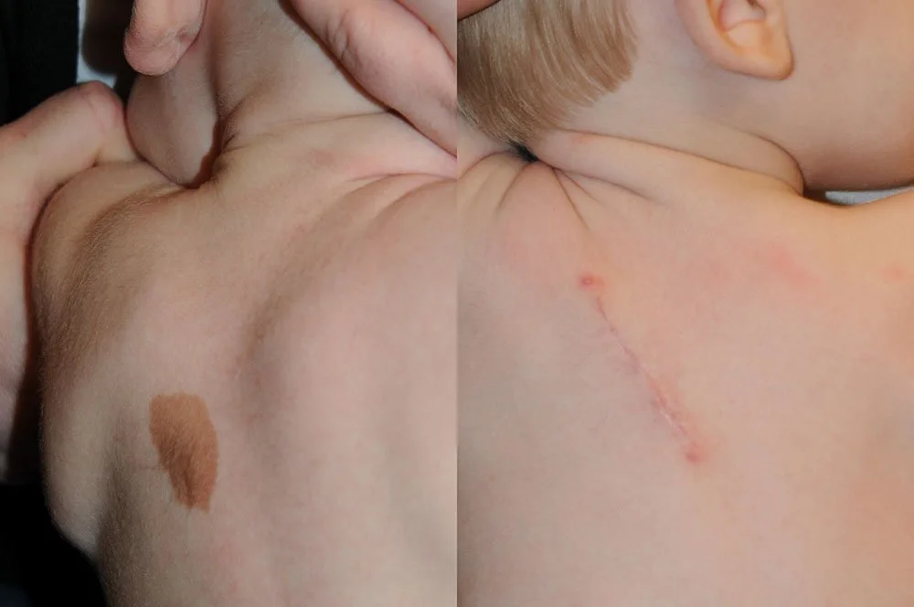 congenital-nevus-2.jpg