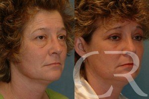 blepharoplasty-25.jpg