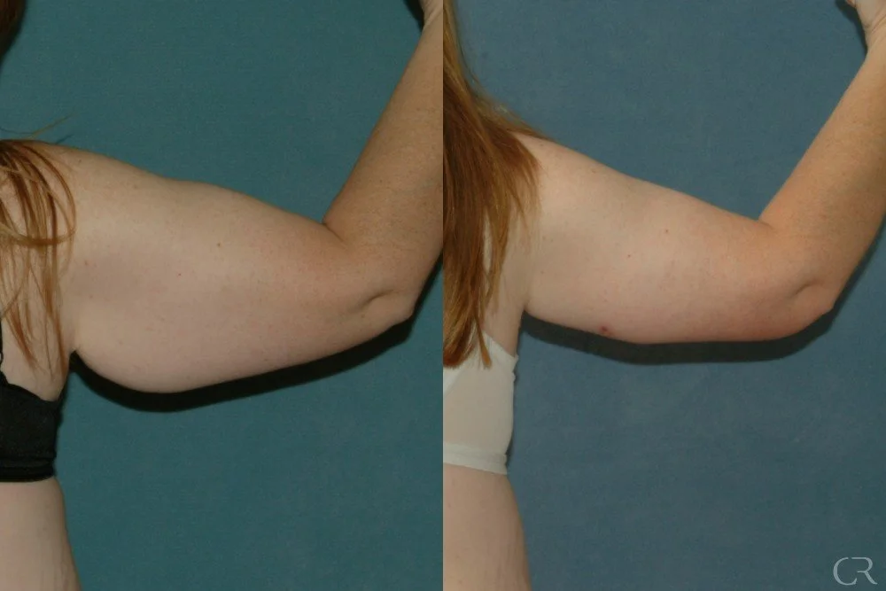 brachioplasty-10.jpg