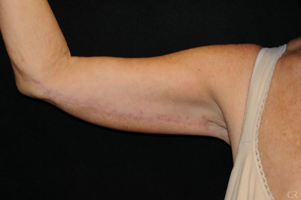 brachioplasty-8.jpg