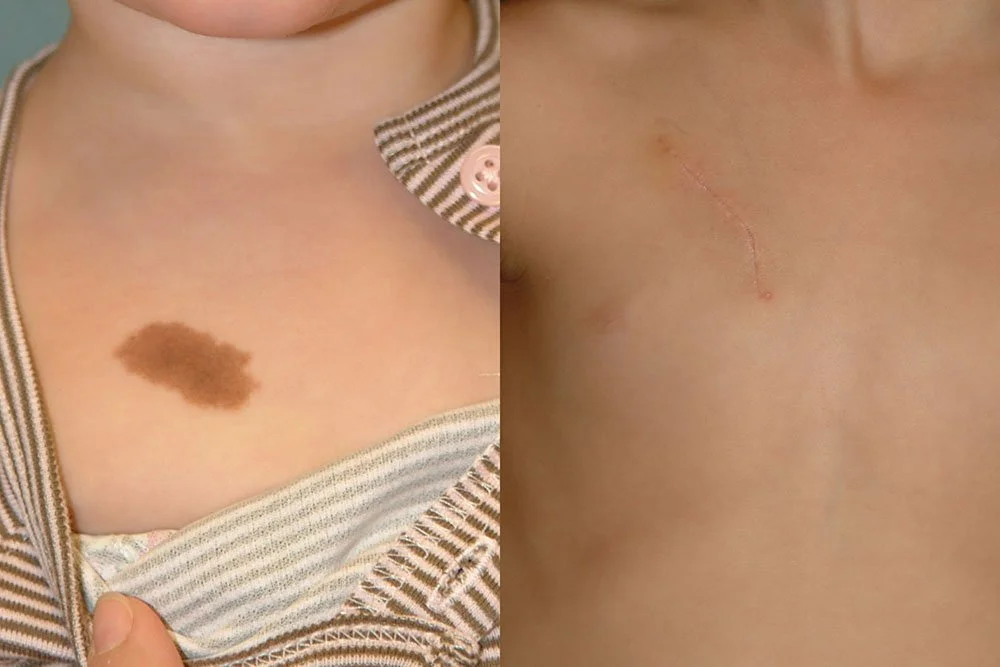 congenital nevus (5)(1).jpg