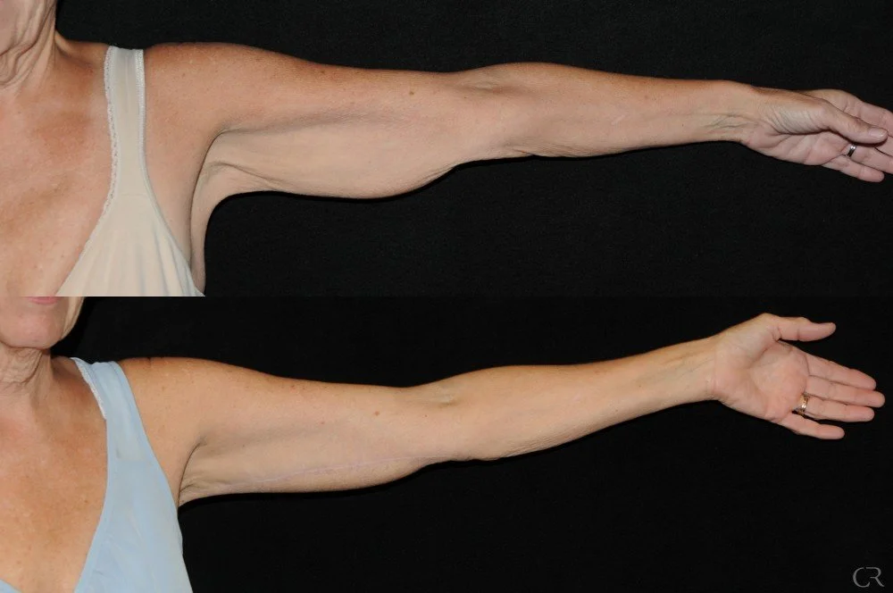 brachioplasty-6.jpg