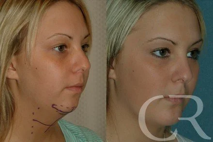 chin-augmentation-3.jpg
