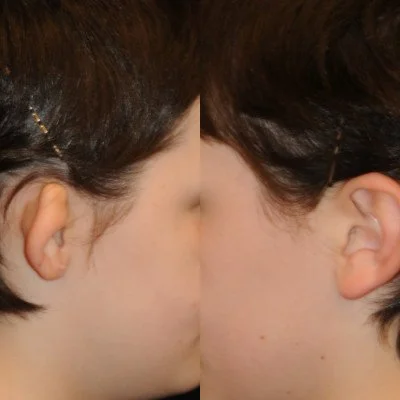ear-reconstruction-13.jpg