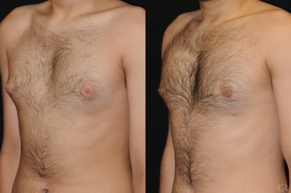 chest-gynecomastia-4.jpg