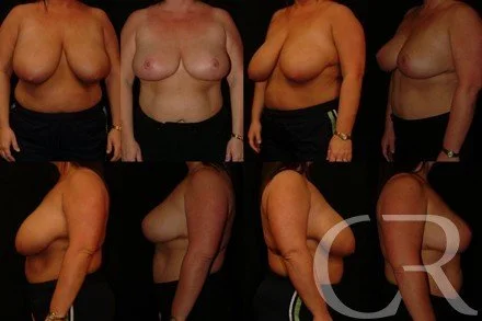 breast-reduction-7.jpg