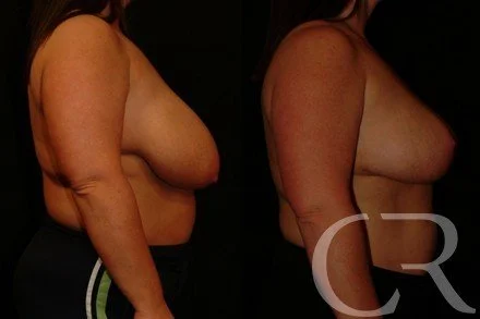 breast-reduction-10.jpg