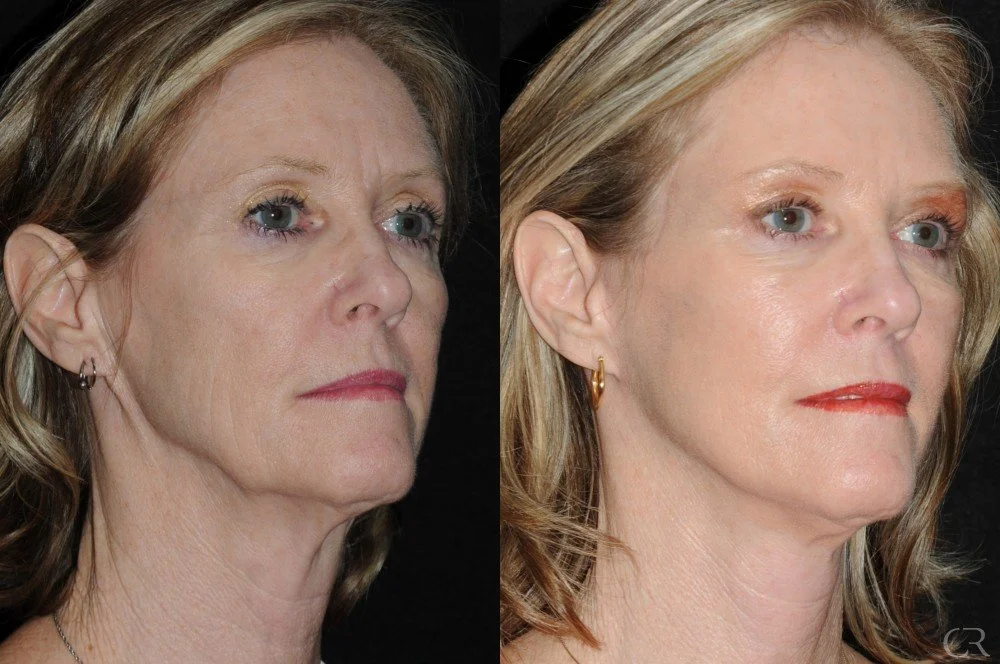 facelift-necklift-8.jpg