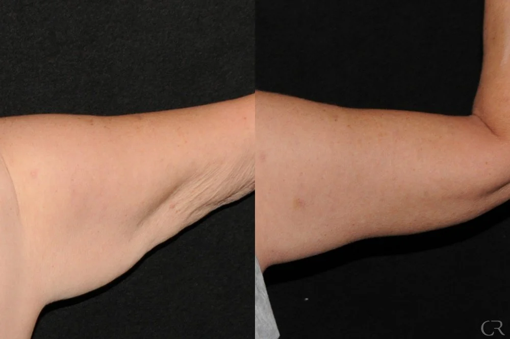 brachioplasty-1.jpg