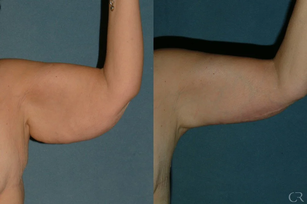 brachioplasty-13.jpg