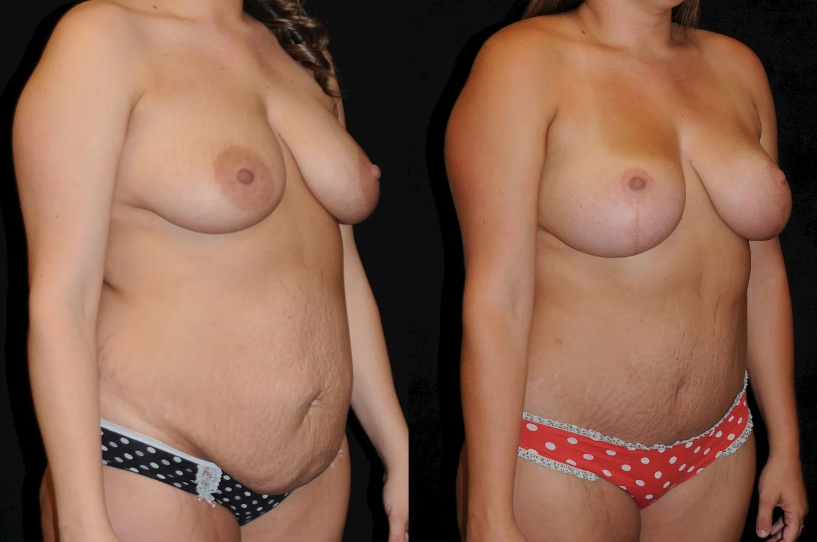mommy makeover abdominoplasty mastopex (1).jpg
