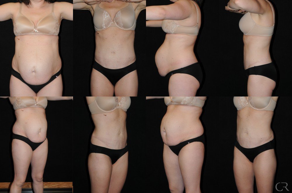 abdominoplasty-11.jpg