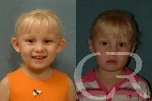pediatric-otoplasty-4.jpg