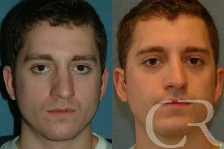 rhinoplasty-8.jpg