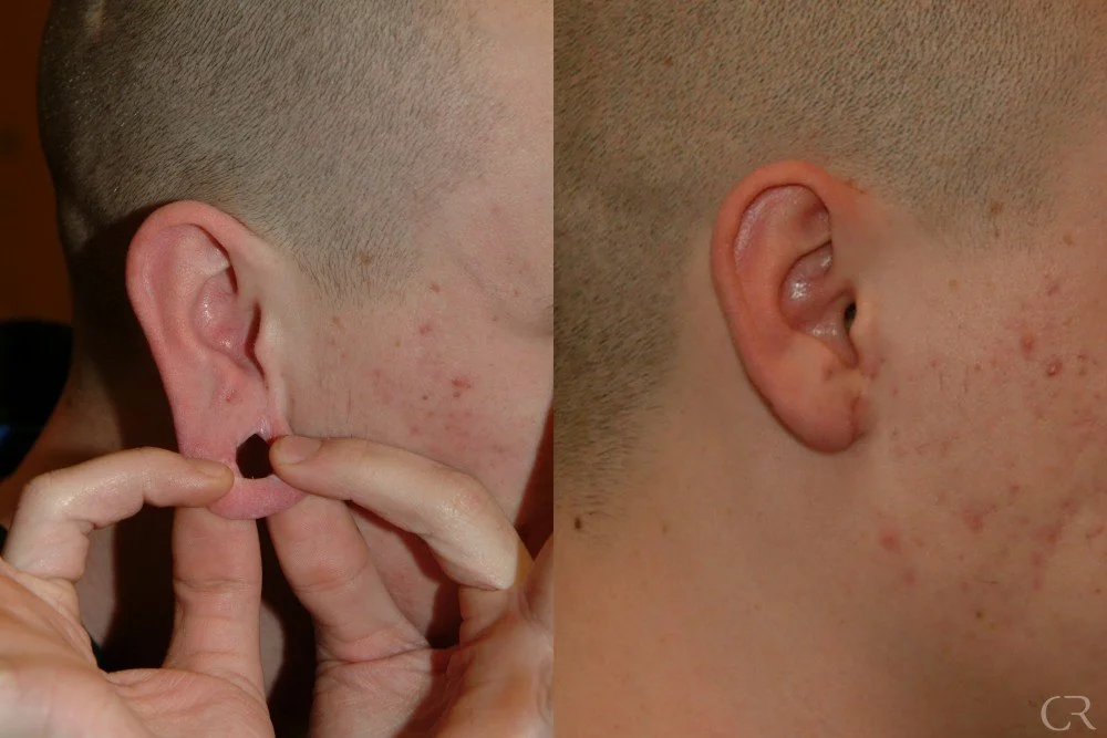 ear-reconstruction-1.jpg