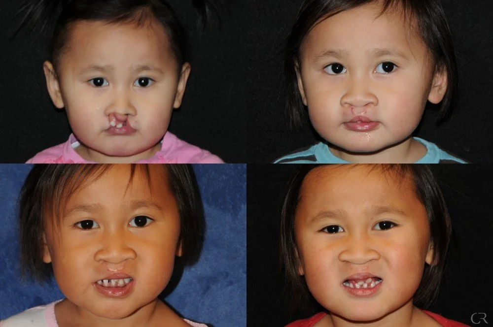 cleft-lip-8.jpg