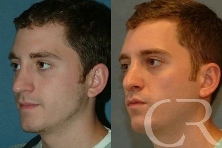 rhinoplasty-5.jpg