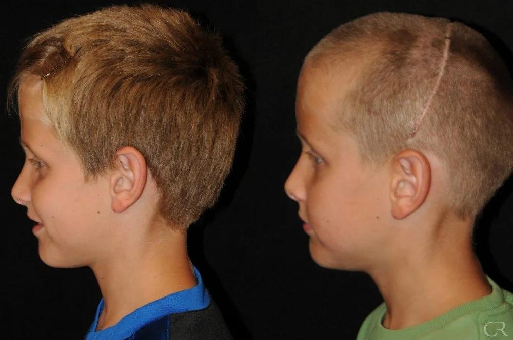 craniosynostosis-12.jpg