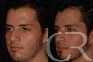 rhinoplasty-12.jpg