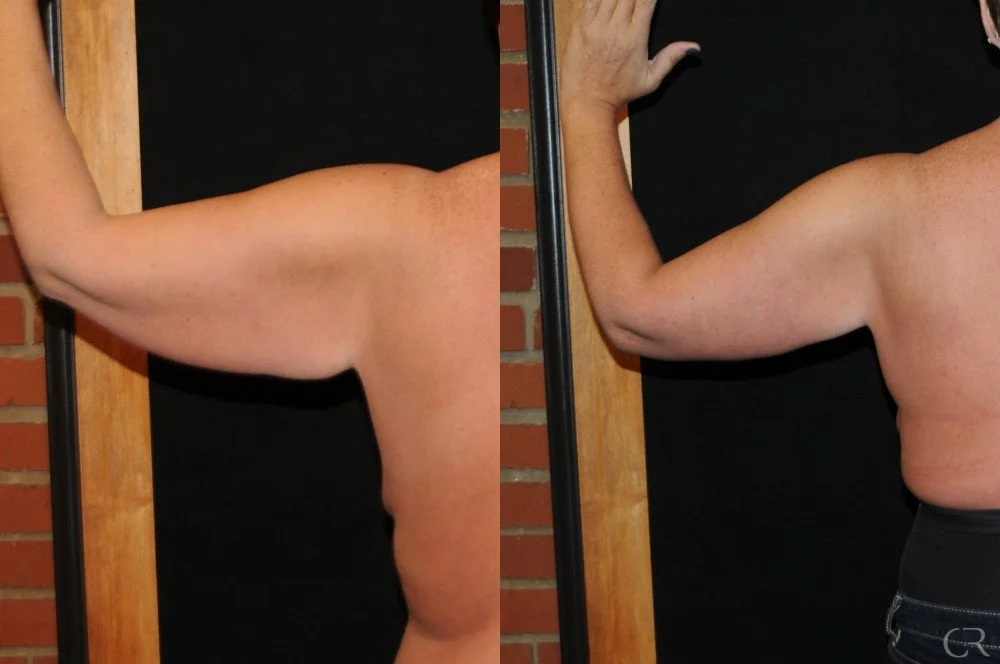 brachioplasty-2.jpg