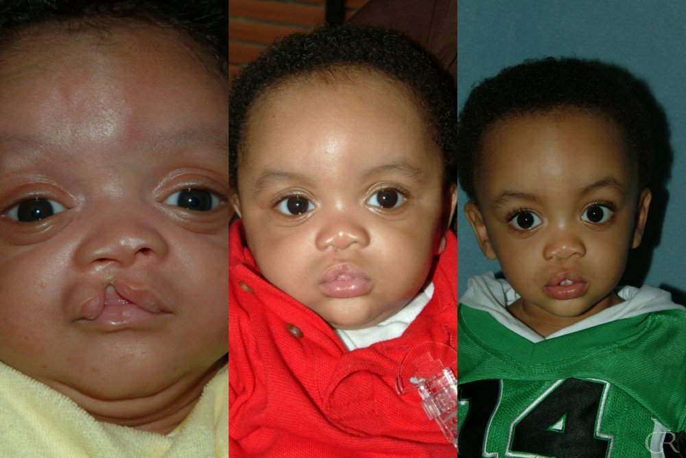 cleft-lip-11.jpg