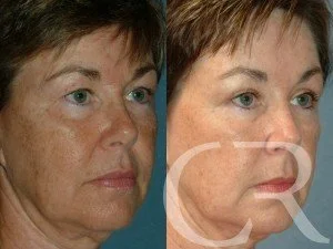 blepharoplasty-5.jpg