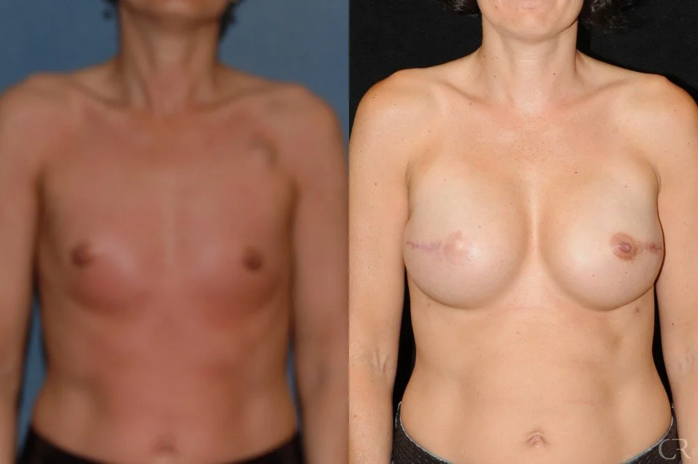 breast-reconstruction-2.jpg