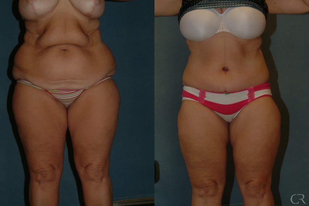 abdominoplasty-4.jpg