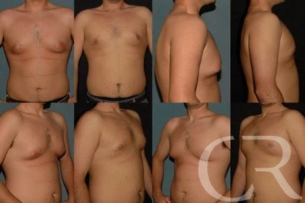 chest-gynecomastia-14.jpg