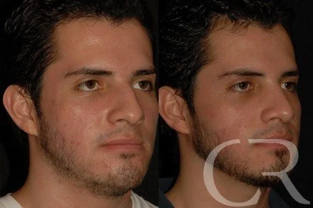rhinoplasty-11.jpg