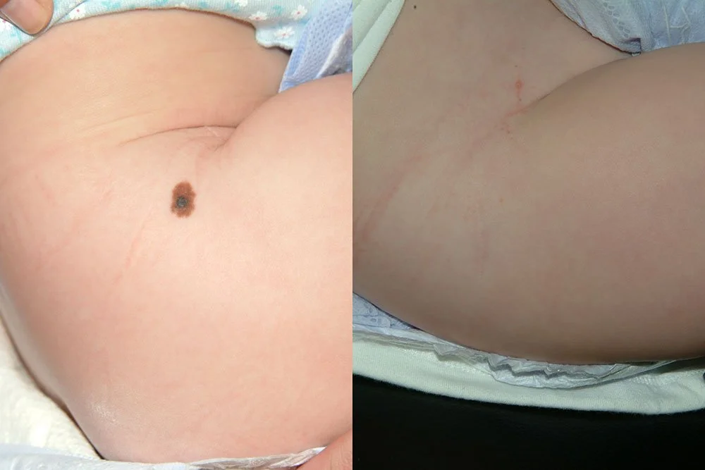 congenital nevi-10.jpg