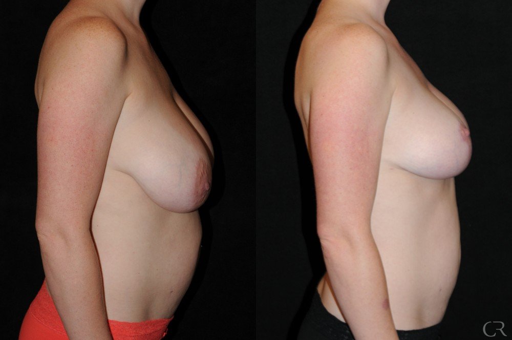 mastopexy-10.jpg