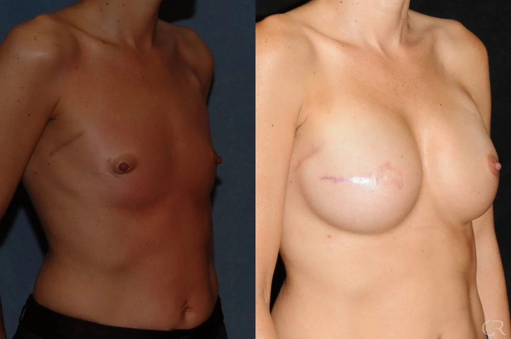 breast-reconstruction-4.jpg