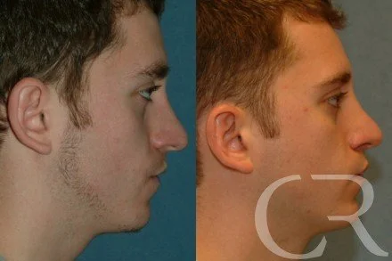 rhinoplasty-7.jpg