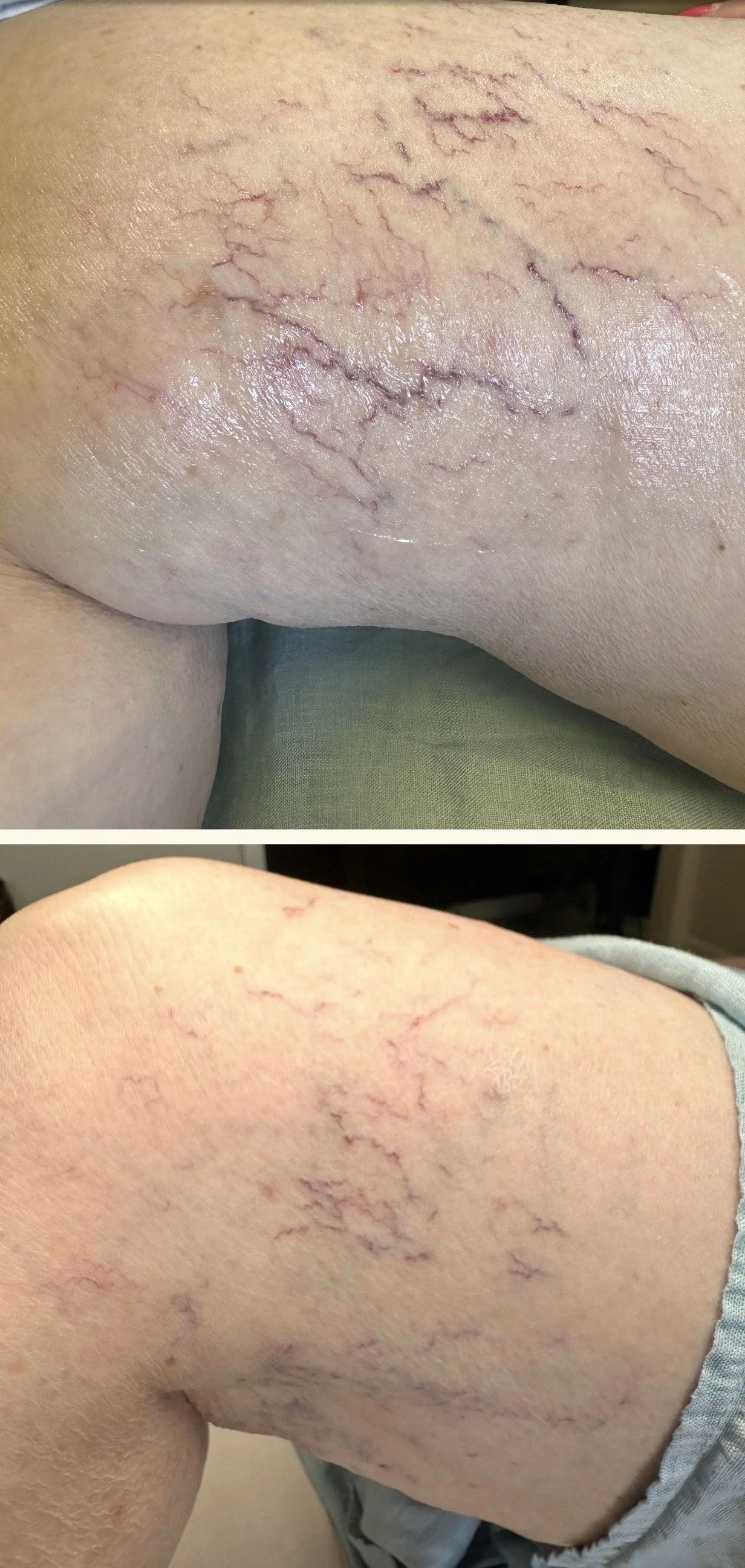 After 3 Vascular Sessions (Spider Veins)