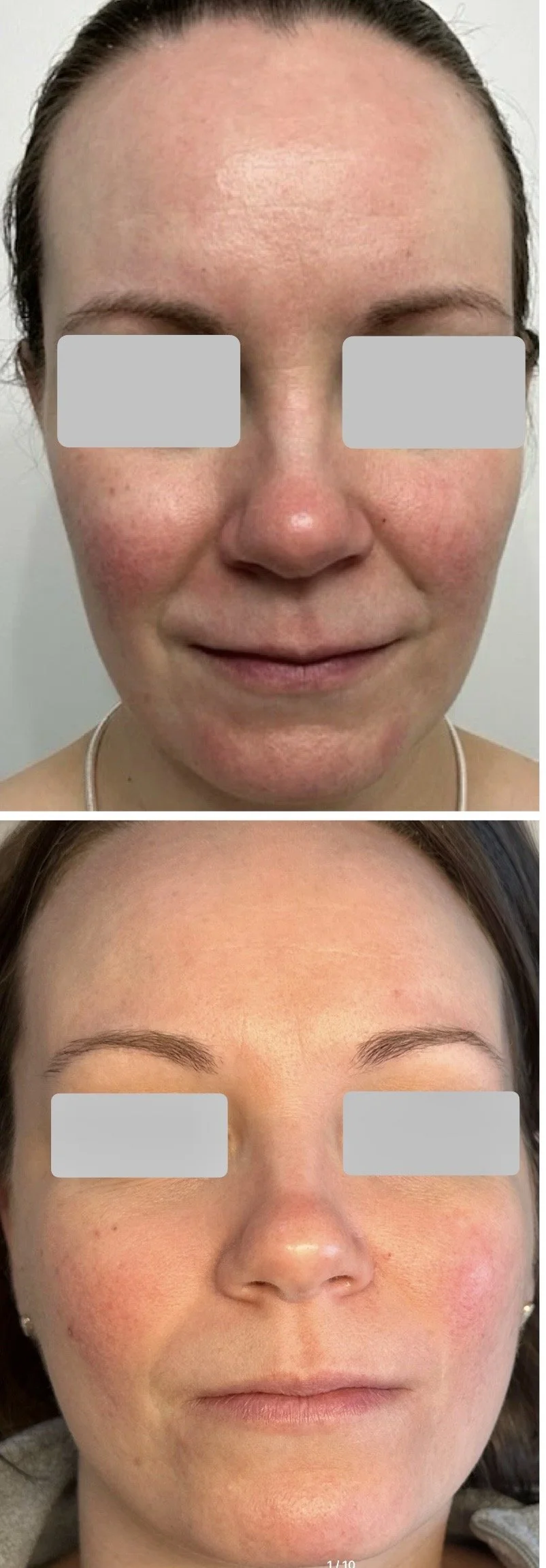 After 3 Photofacial Sessions for Rosacea