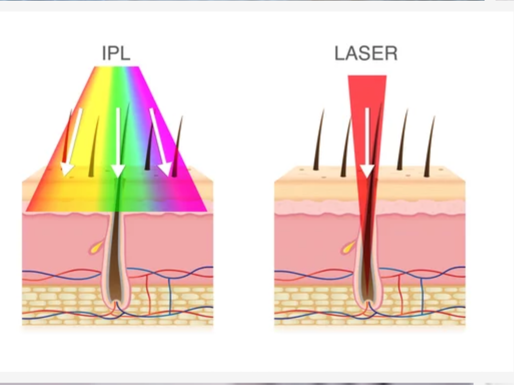 Is IPL Right for You? A Super Easy Guide to Photofacials!