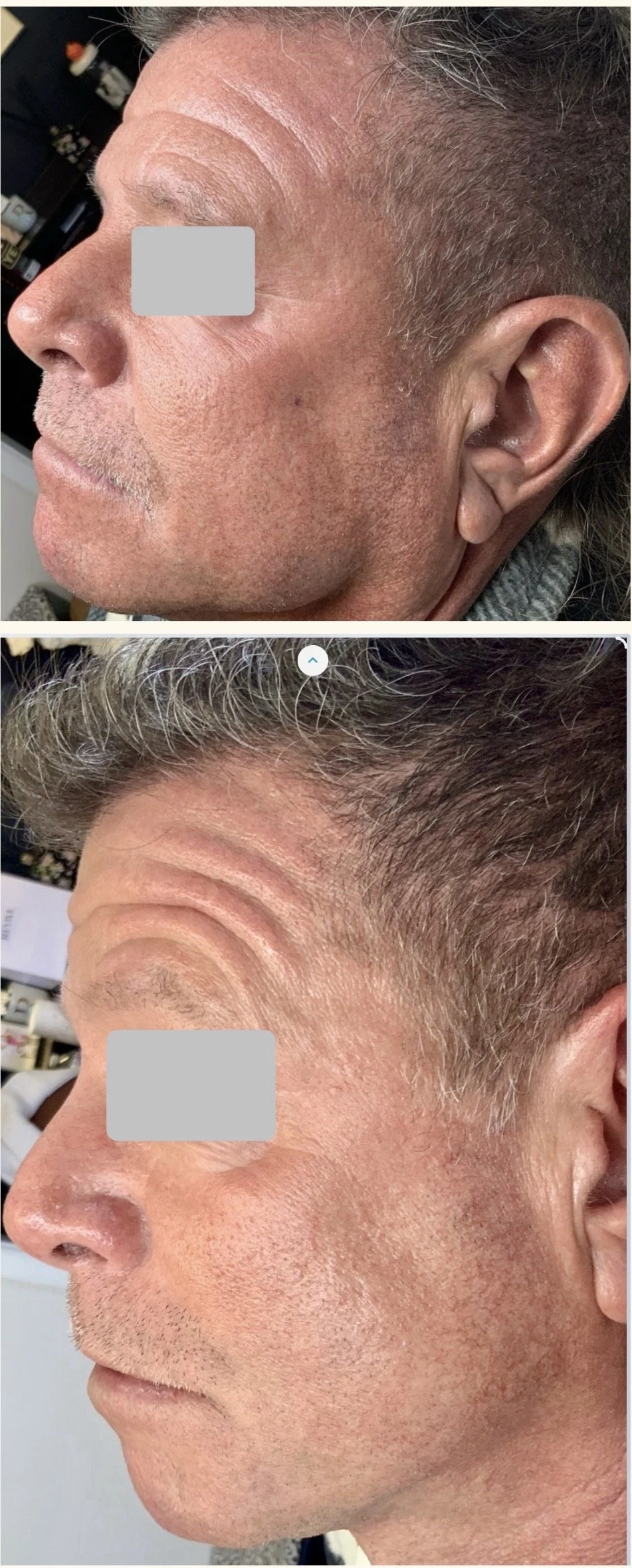 After 3 Photofacial Sessions
