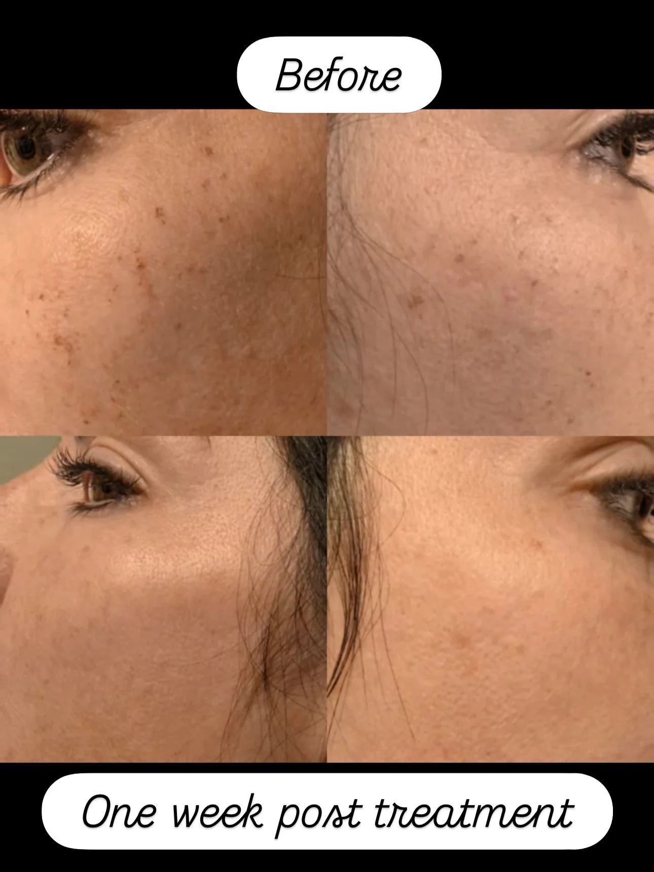 After 1st Photofacial Session