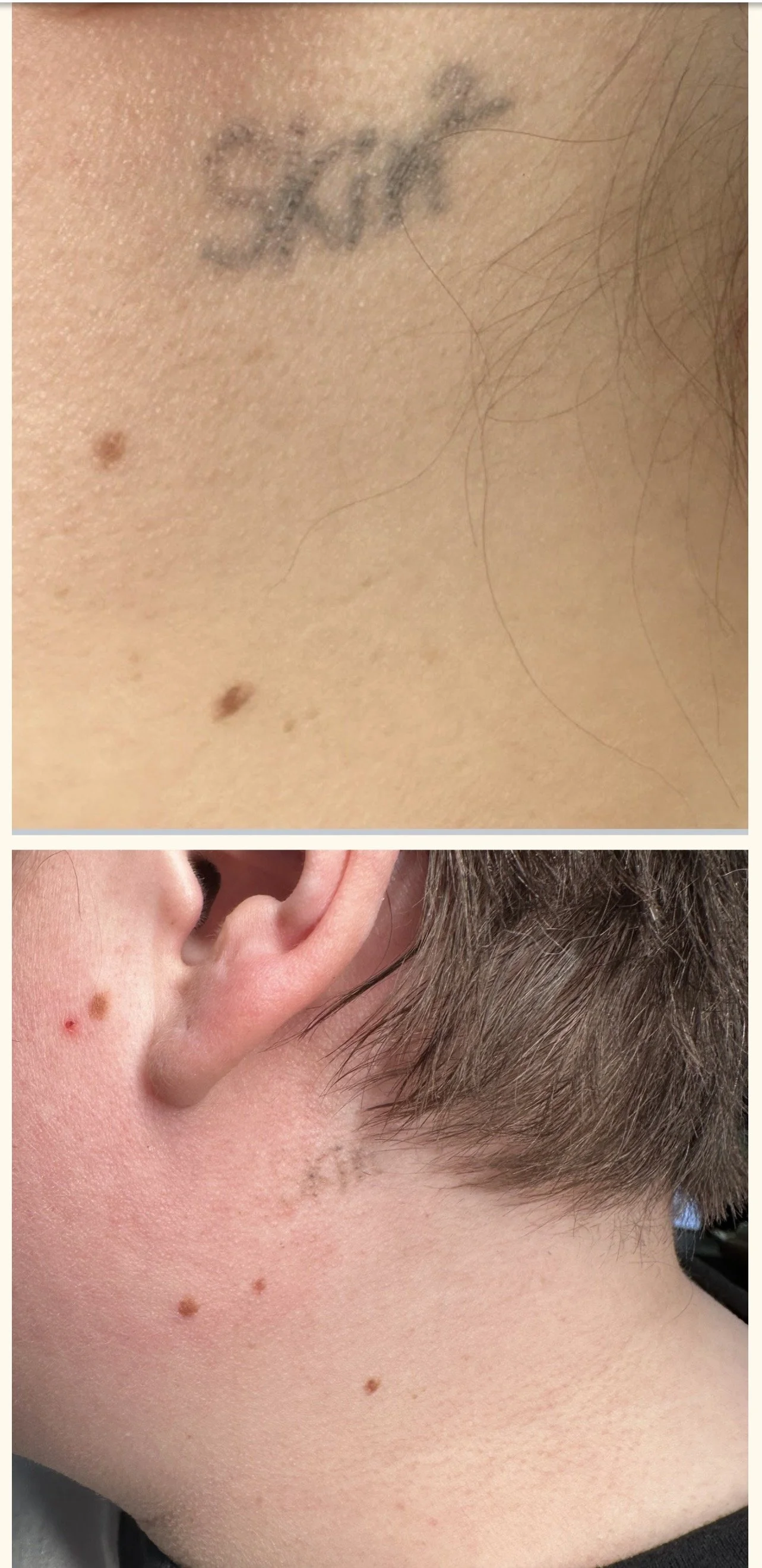 8 Weeks after 1st Tattoo Removal Session