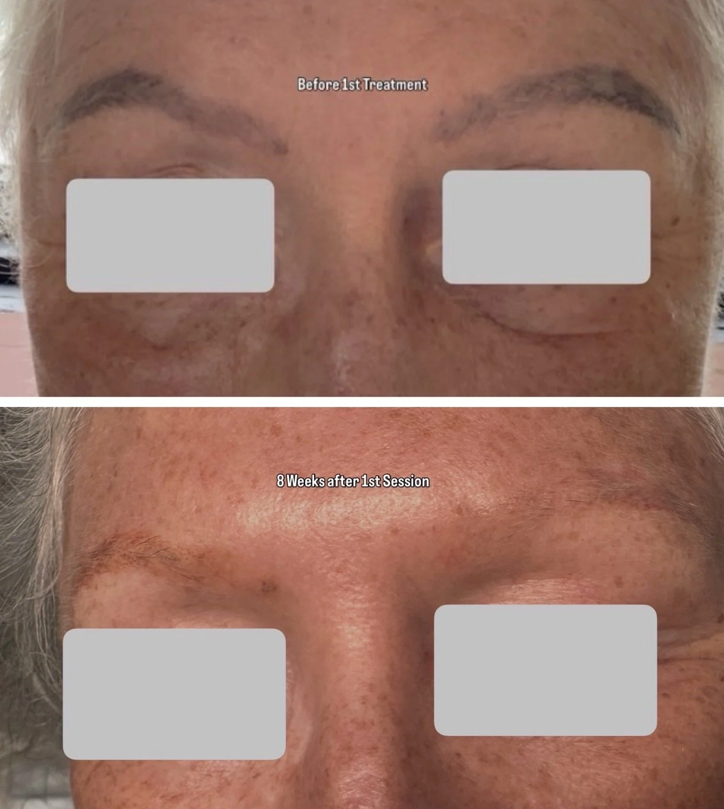 Tattoo Removal on Brows