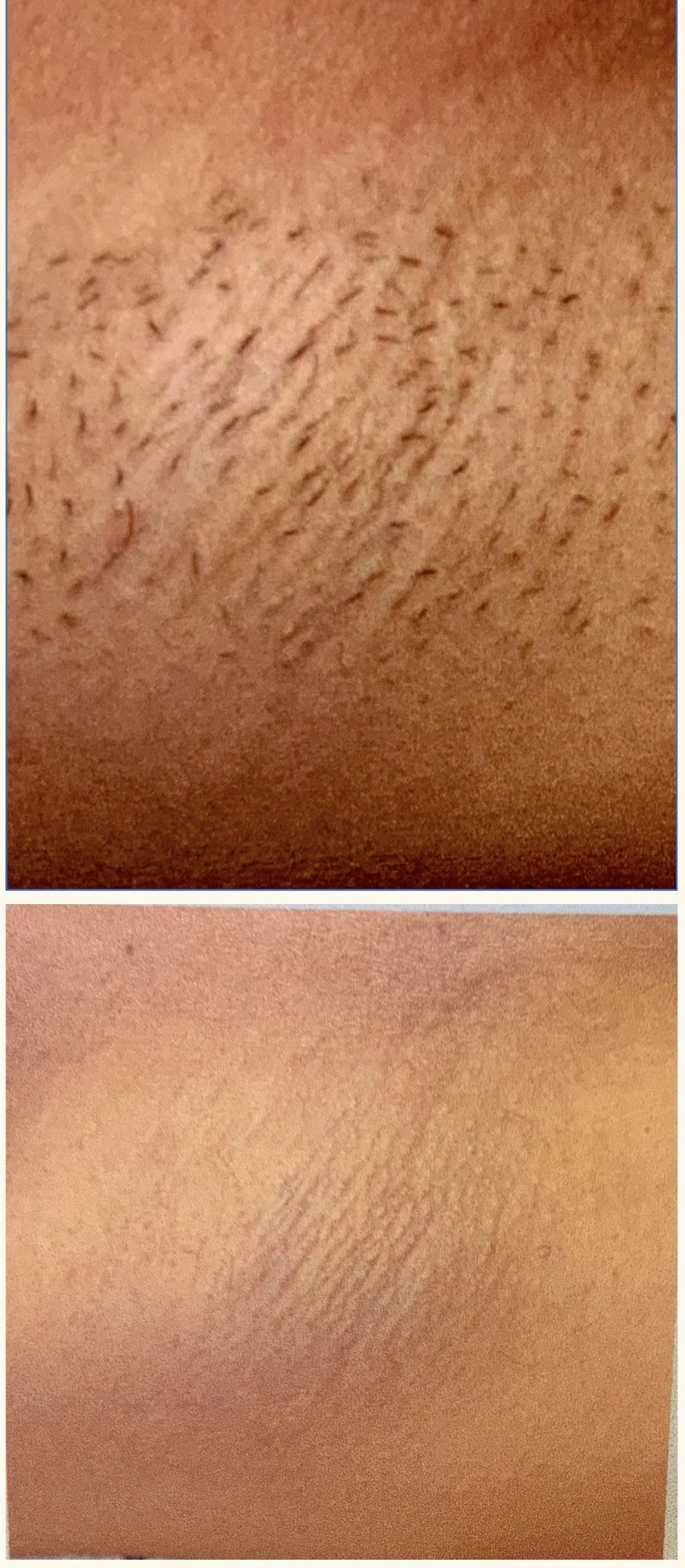 After 6 Sessions IPL Hair Removal