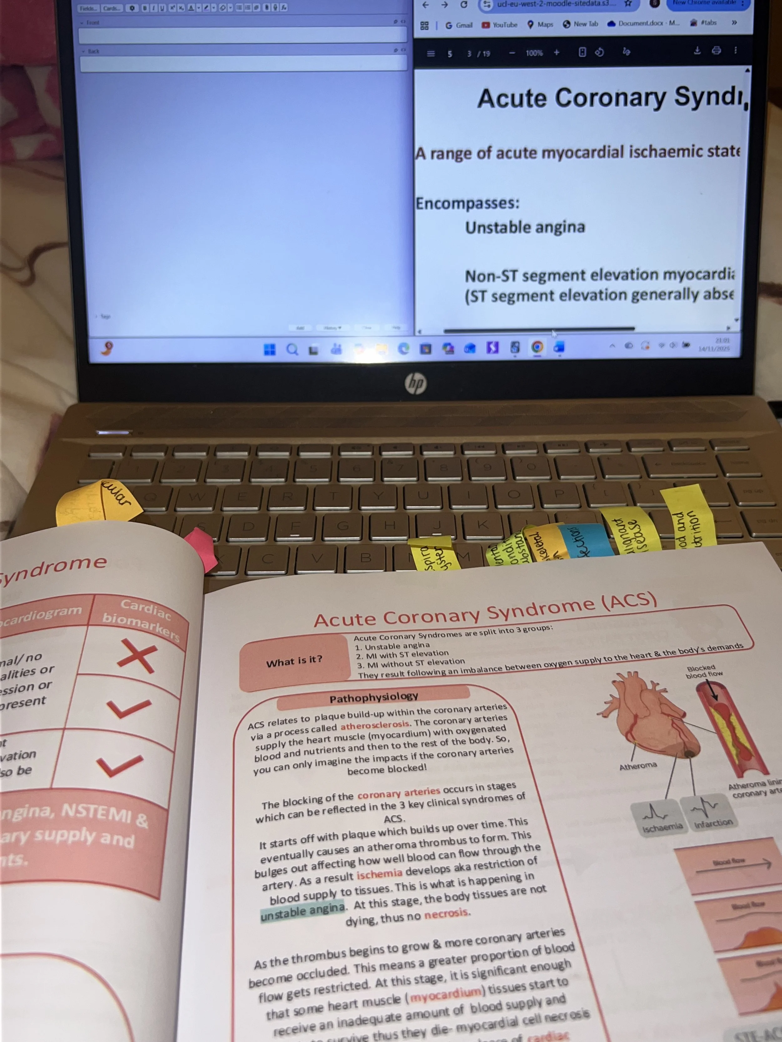 A study or classroom setting with a laptop displaying a presentation on Acute Coronary Syndrome, alongside an open textbook with notes and highlighters, and sticky notes on the laptop.