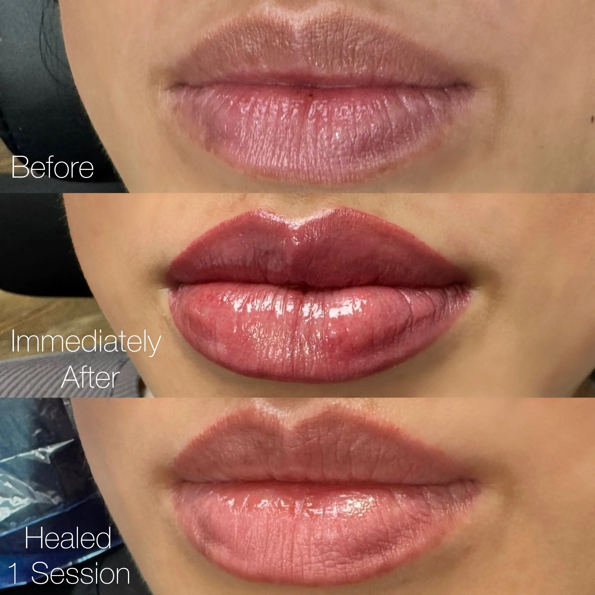 Sequence of three photos showing a woman's lips before, immediately after, and healed after a cosmetic lip procedure. The first image shows natural, dry lips. The second displays lips with fresh, dark lipstick. The third shows lips with healed, light