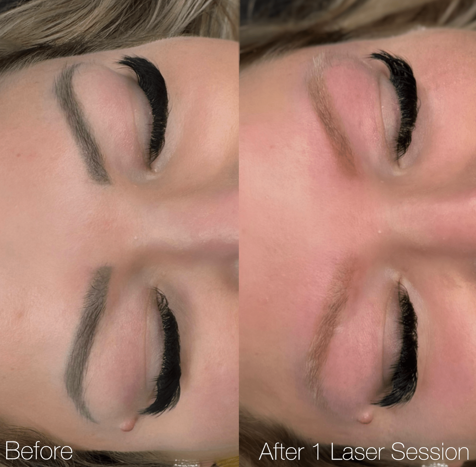 Starting Fresh: Laser Tattoo Removal for Your Permanent Makeup