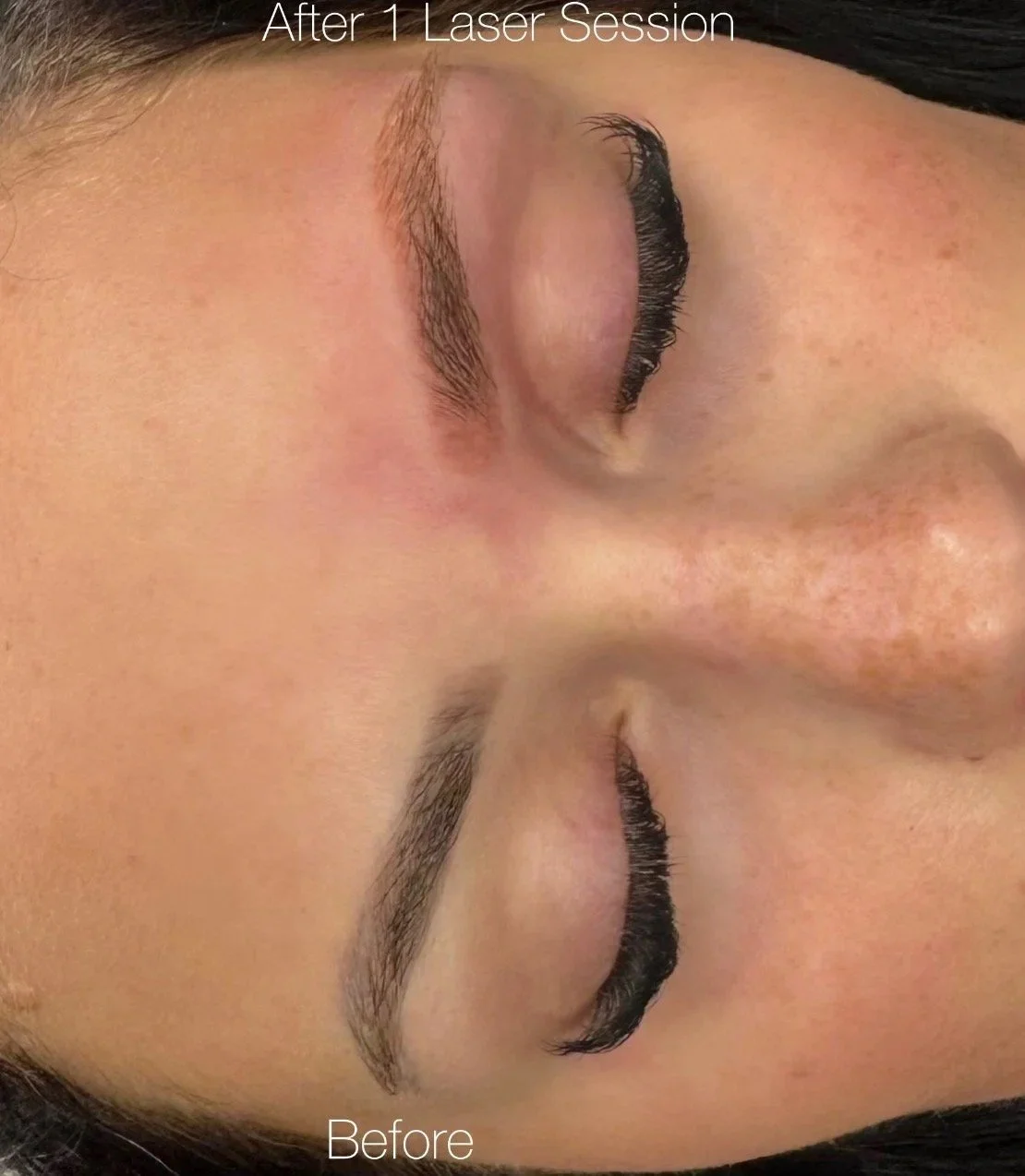 Laser vs. Saline Removal: What Actually Works for Permanent Makeup